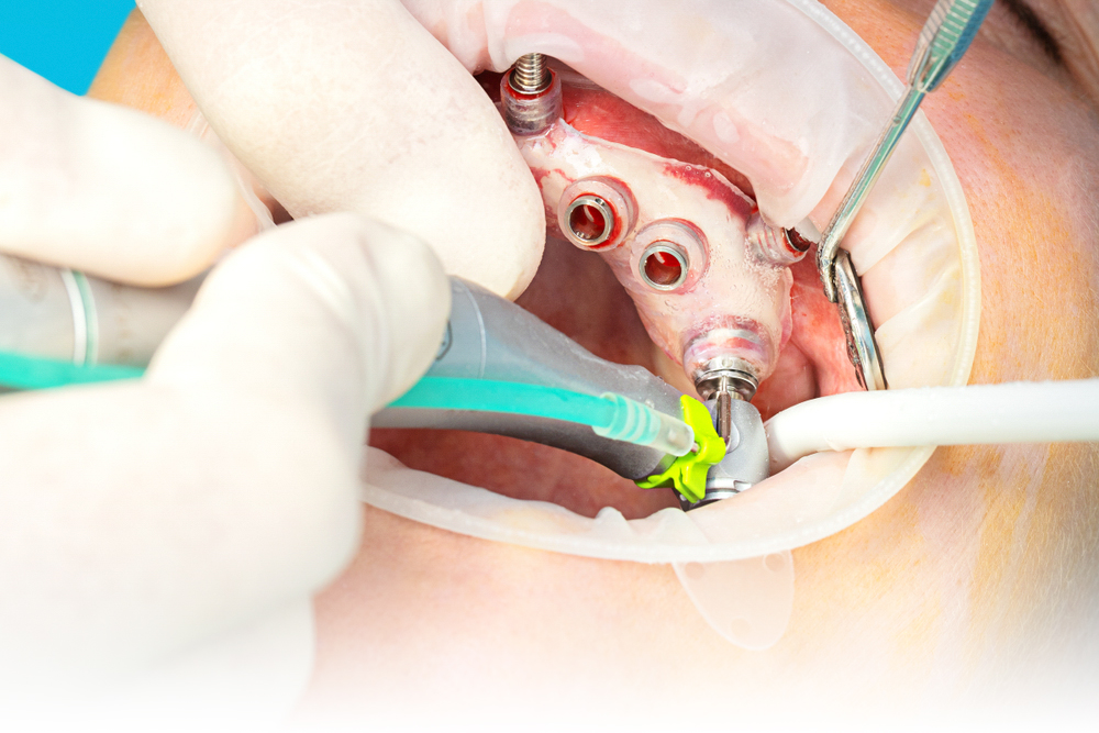 Mini Dental Implant procedure